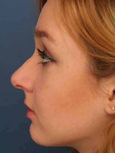Before Image: Rhinoplasty - left-side