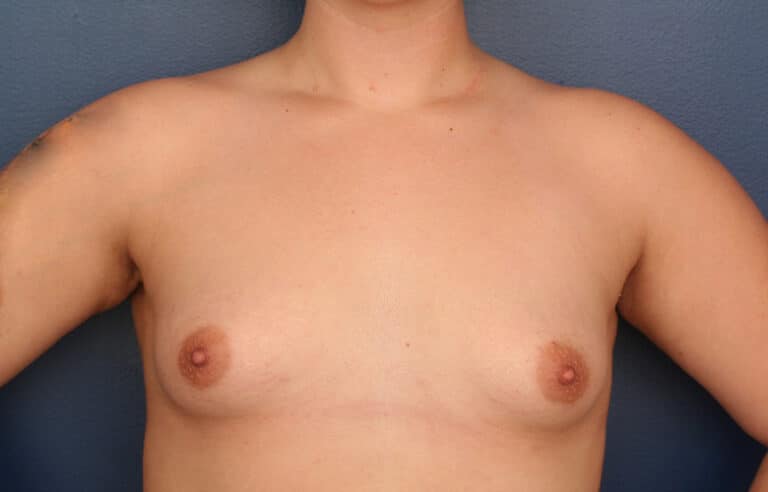 Before Image: Breast Augmentation - front