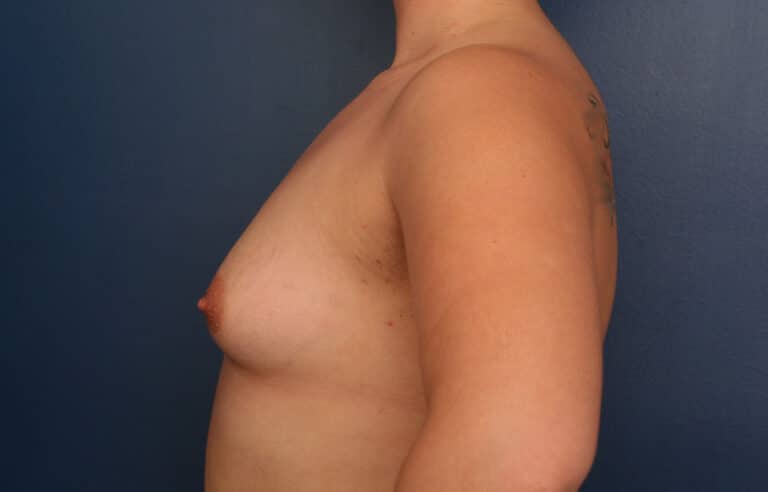 Before Image: Breast Augmentation - left-side