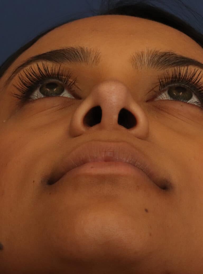 After Image: Ethnic Rhinoplasty - front
