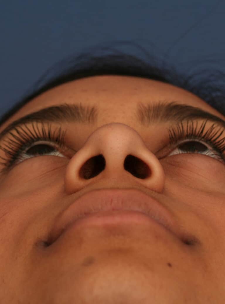 Before Image: Ethnic Rhinoplasty - front