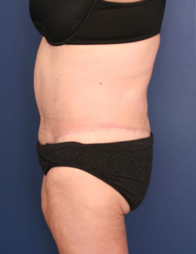 After Image: After Large Weight Loss - left-side