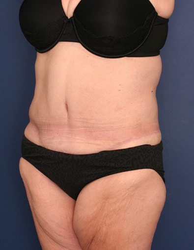 After Image: After Large Weight Loss - left-front-oblique