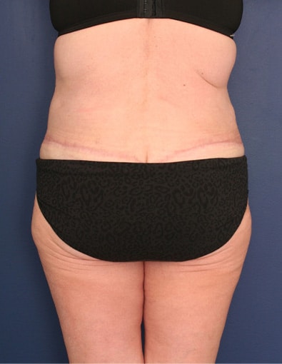 After Image: After Large Weight Loss - back