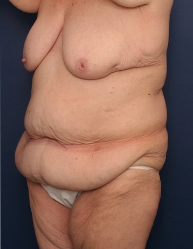 Before Image: After Large Weight Loss - left-front-oblique
