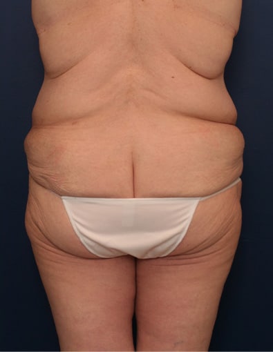 Before Image: After Large Weight Loss - back