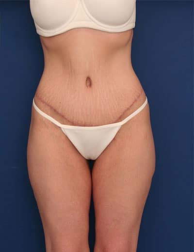 After Image: After Large Weight Loss - front