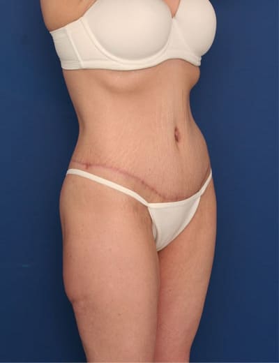 After Image: After Large Weight Loss - right-front-oblique