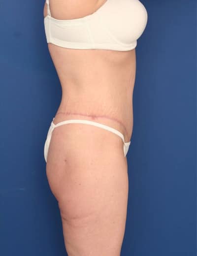 After Image: After Large Weight Loss - right-side