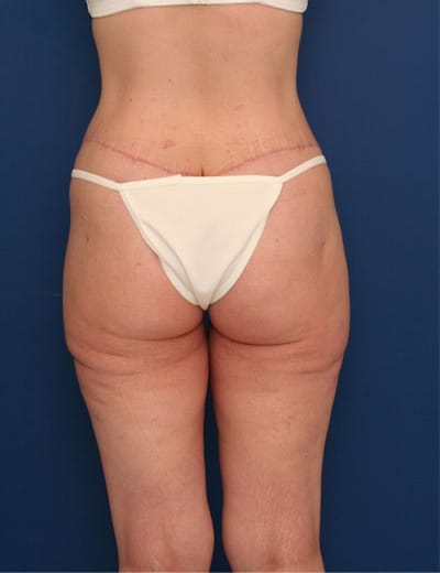 After Image: After Large Weight Loss - back