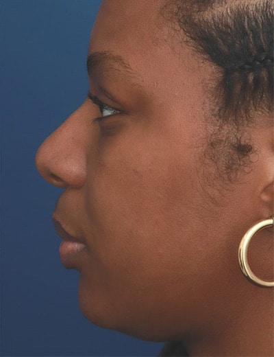 After Image: Ethnic Rhinoplasty - left-side