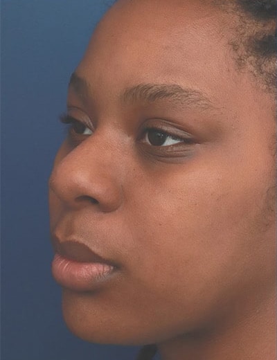 Before Image: Ethnic Rhinoplasty - left-front-oblique