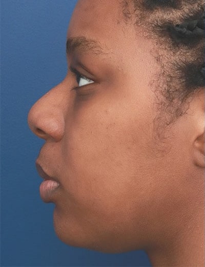 Before Image: Ethnic Rhinoplasty - left-side