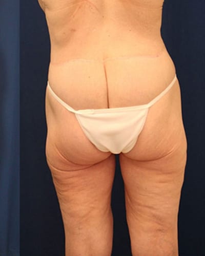 After Image: After Large Weight Loss - back