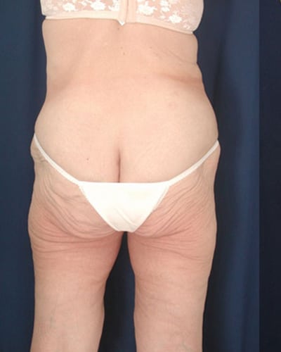 Before Image: After Large Weight Loss - back