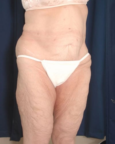 Before Image: After Large Weight Loss - right-front-oblique