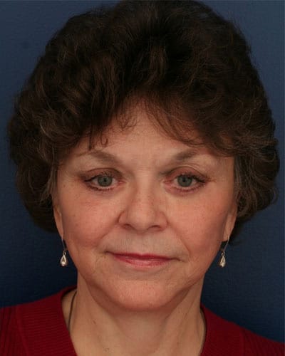After Image: After Large Weight Loss - front