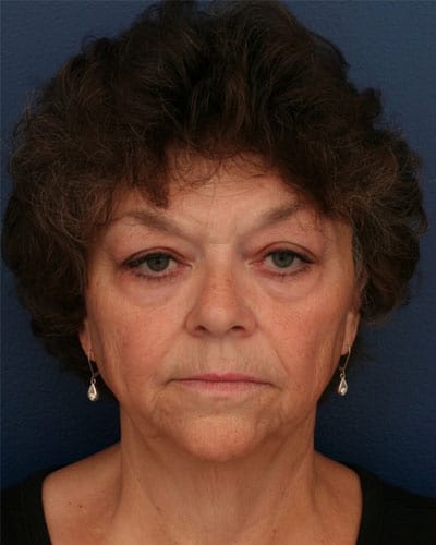 Before Image: After Large Weight Loss - front