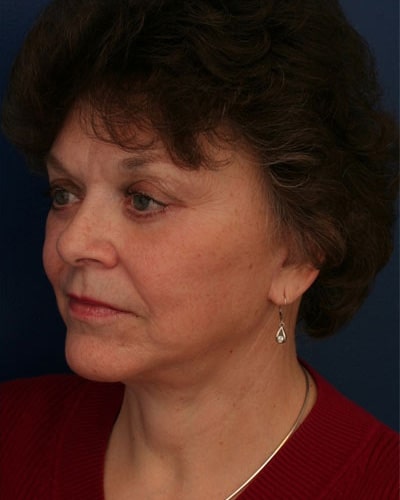 After Image: After Large Weight Loss - left-front-oblique