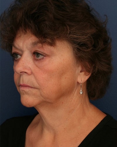 Before Image: After Large Weight Loss - left-front-oblique