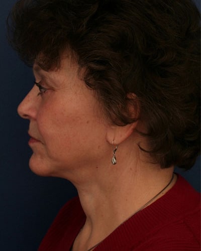 After Image: After Large Weight Loss - left-side