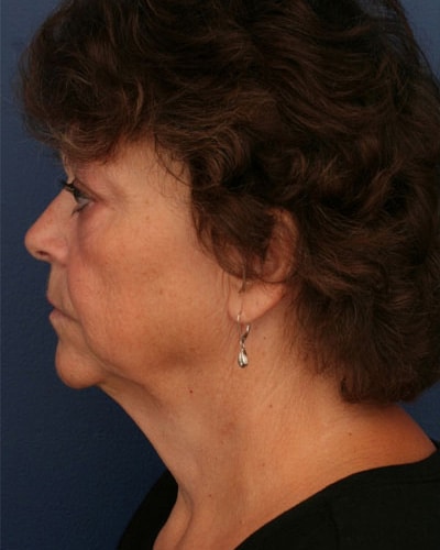 Before Image: After Large Weight Loss - left-side