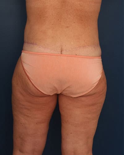 After Image: After Large Weight Loss - back