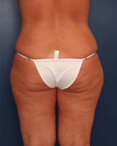 Before Image: After Large Weight Loss - back