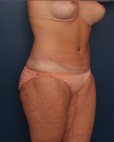 After Image: After Large Weight Loss - right-front-oblique