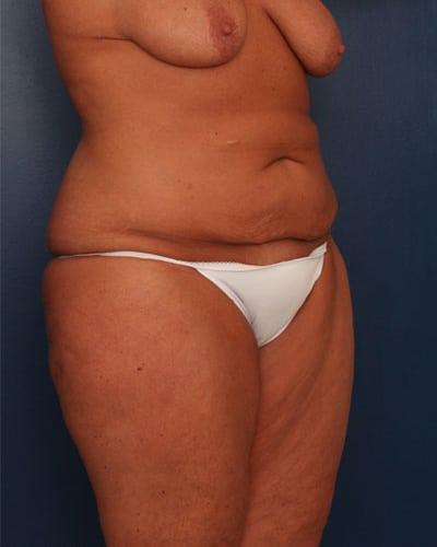 Before Image: After Large Weight Loss - right-front-oblique