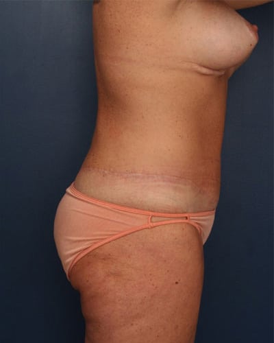 After Image: After Large Weight Loss - right-side
