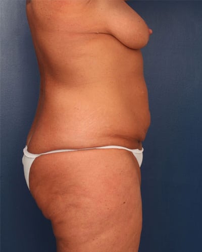 Before Image: After Large Weight Loss - right-side