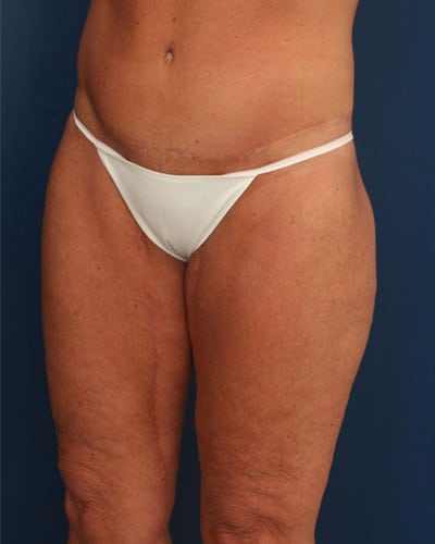 Before Image: After Large Weight Loss - left-front-oblique