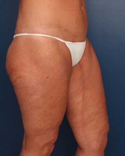 After Image: After Large Weight Loss - left-front-oblique