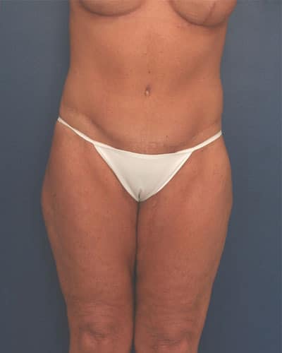After Image: After Large Weight Loss - front
