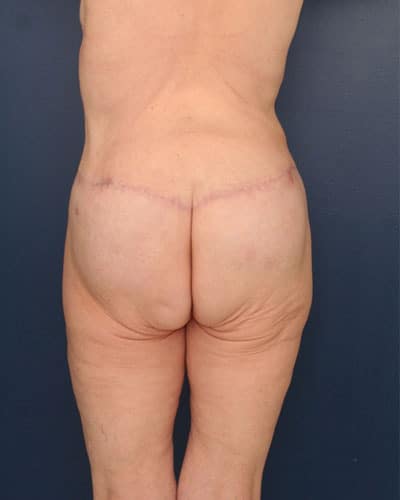 After Image: After Large Weight Loss - back
