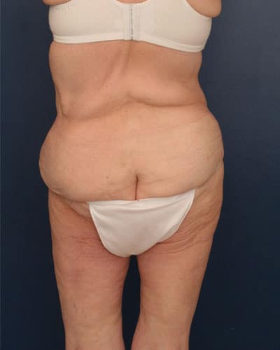 Before Image: After Large Weight Loss - back