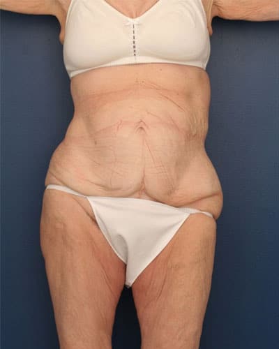 Before Image: After Large Weight Loss - front