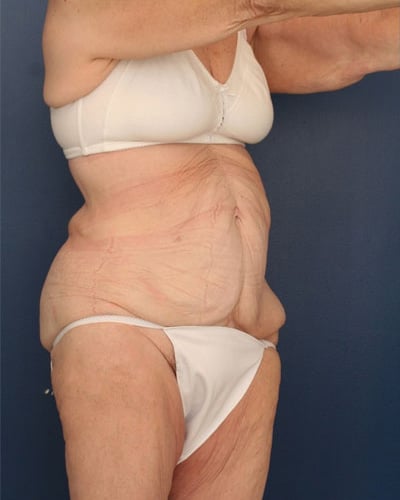 Before Image: After Large Weight Loss - right-front-oblique