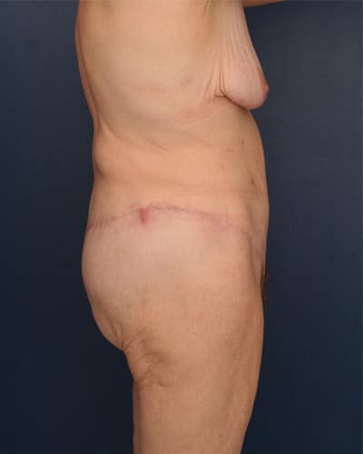 After Image: After Large Weight Loss - right-side