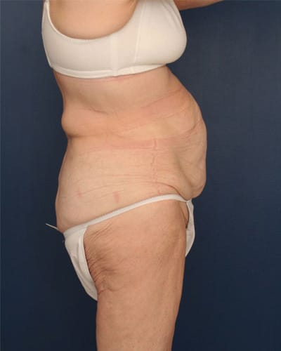 Before Image: After Large Weight Loss - right-side