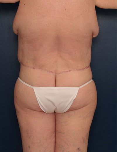After Image: After Large Weight Loss - back
