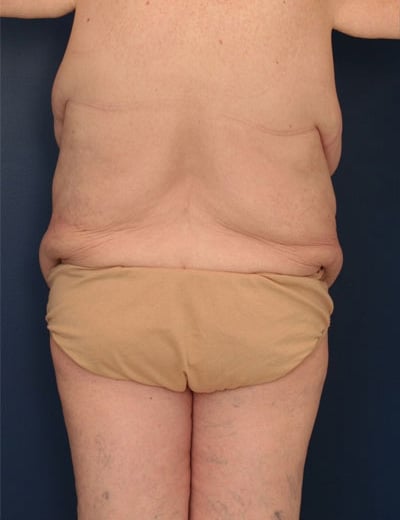 Before Image: After Large Weight Loss - back