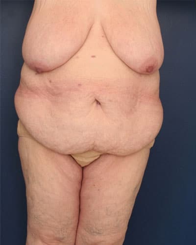 Before Image: After Large Weight Loss - front