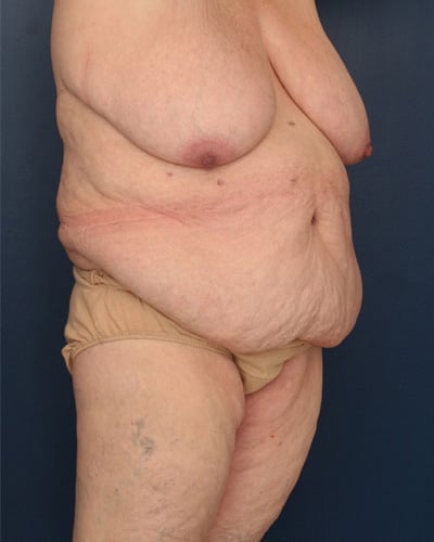 Before Image: After Large Weight Loss - right-front-oblique