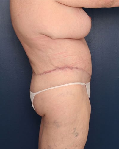After Image: After Large Weight Loss - right-side