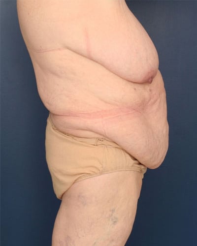 Before Image: After Large Weight Loss - right-side