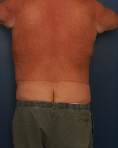 After Image: After Large Weight Loss - back