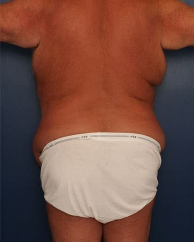 Before Image: After Large Weight Loss - back