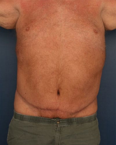 After Image: After Large Weight Loss - front
